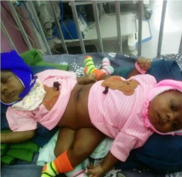 Conjoined Twins at Enugu Hospital