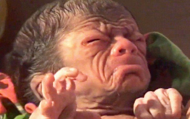 Baby born with Progeria in Bangladesh