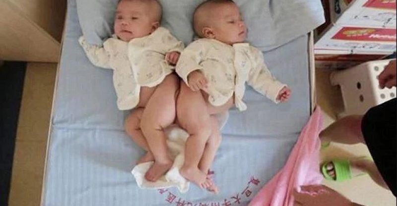 Conjoined Twins Separated